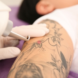 Eliminación de tatuajes y micropigmentación - Medicina estética en Santander