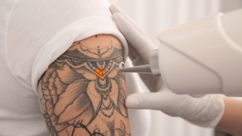 Eliminación de tatuajes y micropigmentación - Medicina estética en Santander