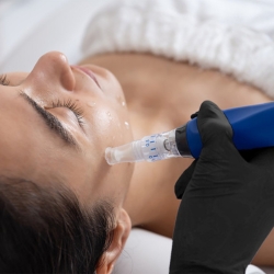 Microneedling (Skinpen) - Medicina Estética Santander