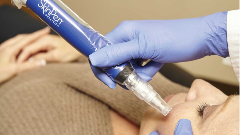 Microneedling (Skinpen) - Medicina Estética Santander