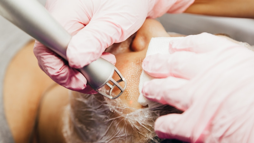 Resurfacing fraccionado ablativo - Medicina Estética Santander