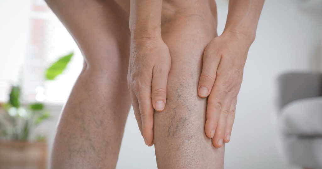 Eliminación de varices sin cirugía