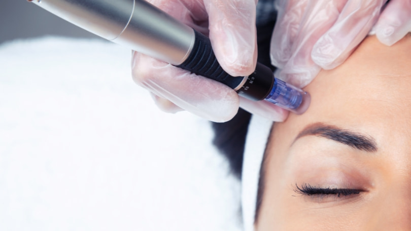 Microneedling con SKINPEN en Santander - Medicina Estética Santander