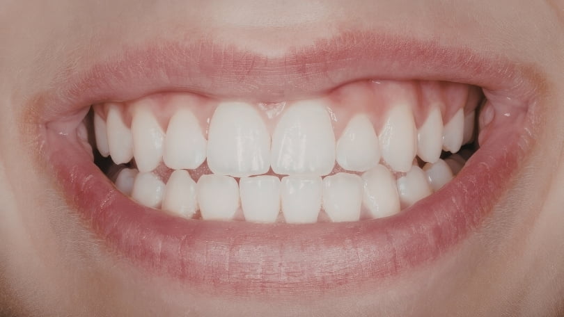 Cómo eliminar la sonrisa gingival sin cirugía