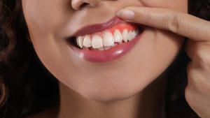 Cómo eliminar la sonrisa gingival sin cirugía
